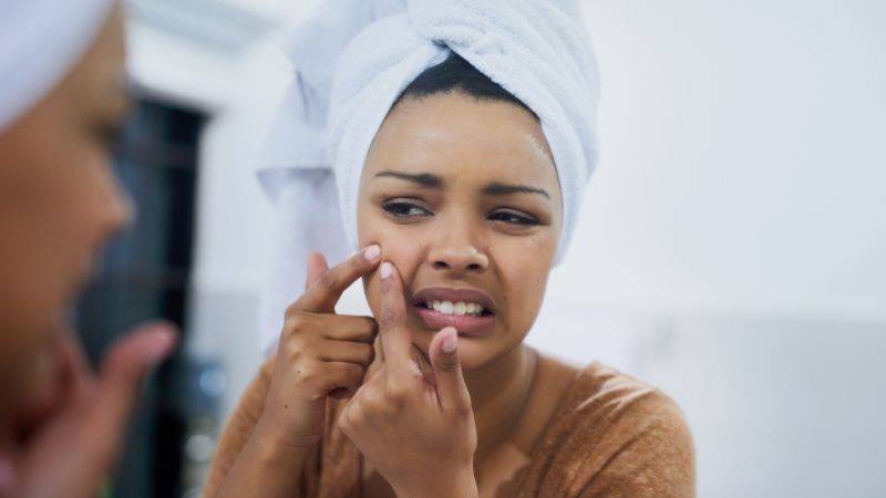 Home Remedies and Tips for Pimples